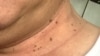 Hỏi đáp Y học: Thịt dư da (Skin tags)